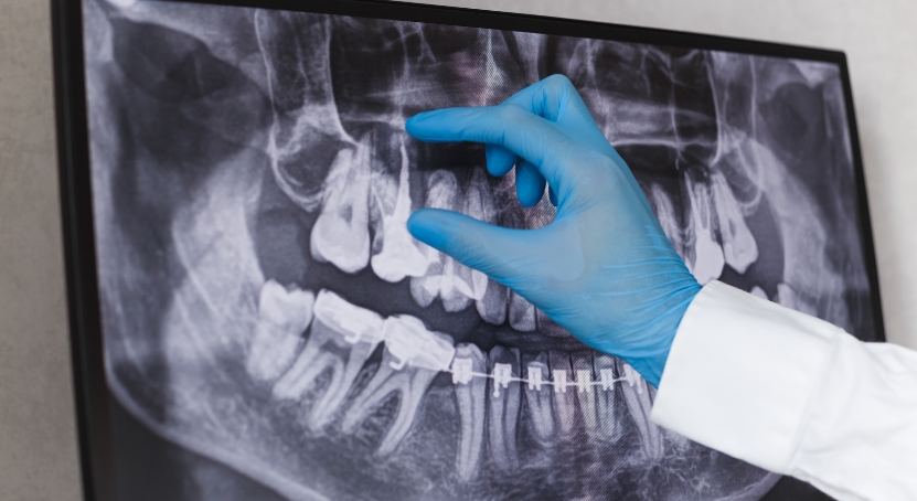 root-canal-treatment-brush-n-floss-dental-victoria